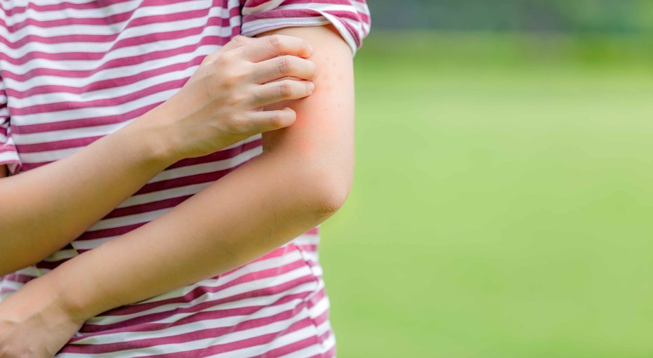 Аллергия На Комаров: 6 Признаков, Что Это Ваш Случай